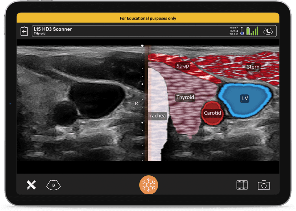 T.mode Clarius 12 AI-Tablet-T-Mode-Thyroid-1024x733