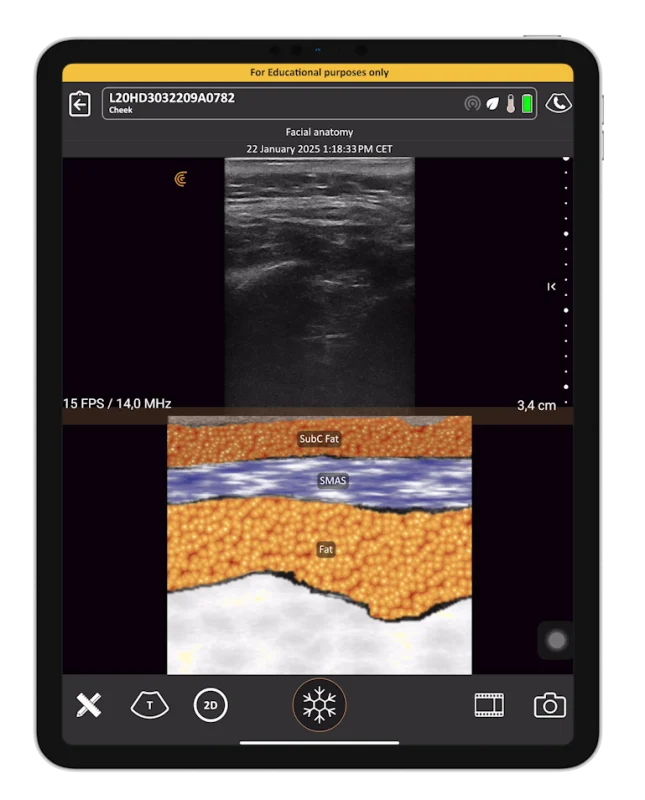 ultrasound identification of the SMAS and DAO